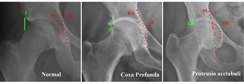 Radiografías mostrando ejemplos de coxa profunda, protrusión acetabular y retroversión craneal