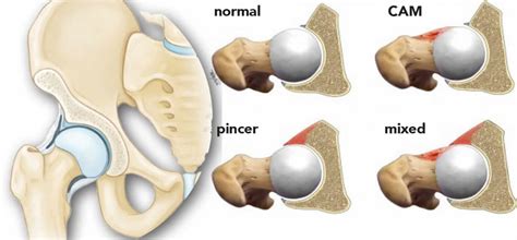 Esquema del atrapamiento femoroacetabular tipo Cam