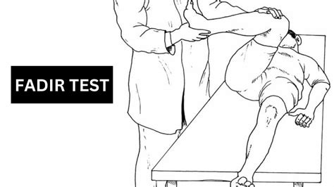 Ilustración de la maniobra de Fadir para evaluar el atrapamiento femoroacetabular