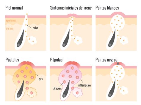 Tipos de lesiones de acné