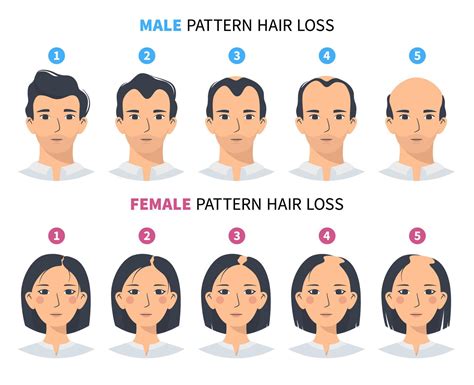 Diferencia entre alopecia androgenética masculina y femenina