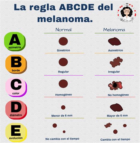 Esquema explicativo de la regla ABCDE del melanoma