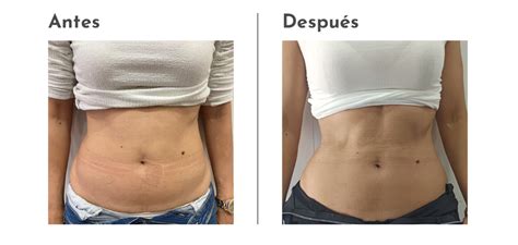 Imagen comparativa antes y después de un tratamiento de mesoterapia para celulitis