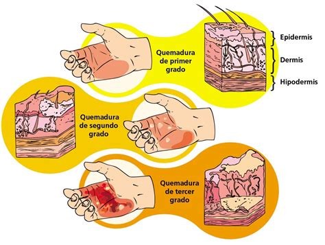 Esquema de las quemaduras internas causadas por el nitrógeno líquido
