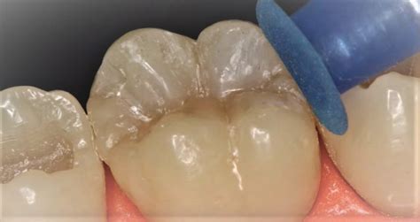Microanatomía dental y pulido de resinas
