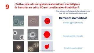 Hematíes isomórficos con forma estrellada debido a la osmolalidad de la orina