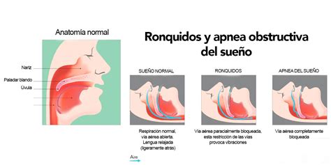 Esquema anatómico de la apertura costal durante la apnea espiratoria