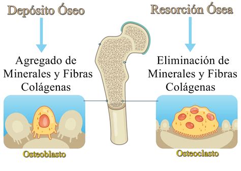 Esquema de la desmineralización ósea