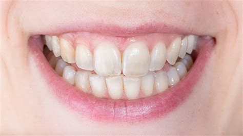 Dientes con esmalte dañado por uso excesivo de abrasivos