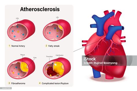 Esquema de las arterias con y sin aterosclerosis