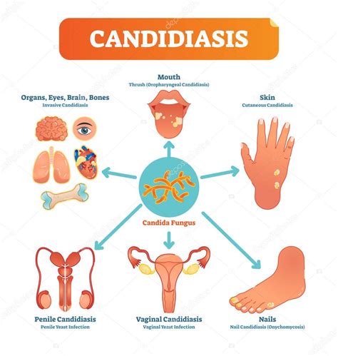 Esquema de las diversas localizaciones de la candidiasis en el cuerpo humano