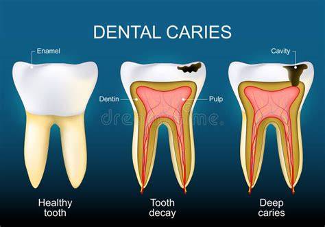 Ilustración de un diente con caries y un empaste dental
