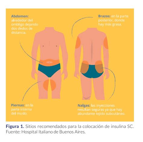 esquema de las zonas de aplicación recomendadas y prohibidas para el parche