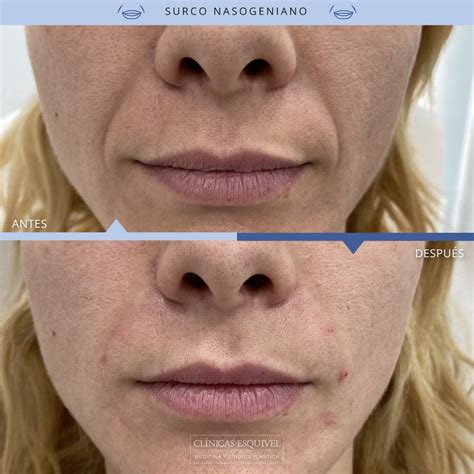 Mujer con surcos nasogenianos antes y después del tratamiento con ácido hialurónico