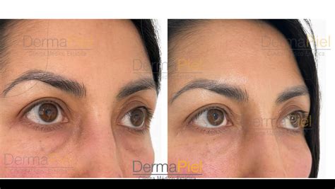 Mujer antes y después del tratamiento de ojeras con ácido hialurónico