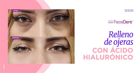 Esquema del procedimiento de inyección de ácido hialurónico en las ojeras
