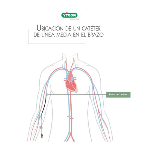 Diagrama de inserción de un catéter de línea media