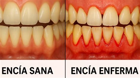 Comparación de encías sanas y con gingivitis
