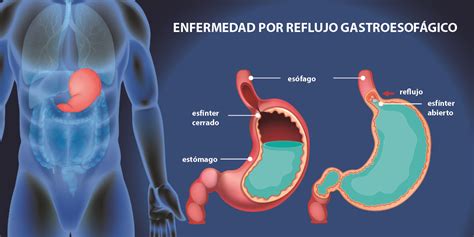 Diagrama del sistema digestivo y el reflujo gástrico