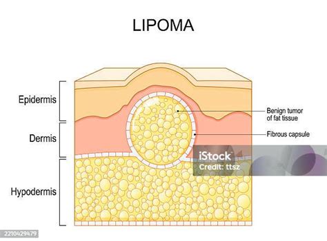 Ilustración de un lipoma.