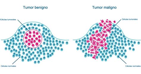 Ilustración de los diferentes tipos de tumores malignos.