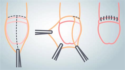 Ilustración de un pene circuncidado y uno no circuncidado