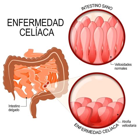 Esquema de la enfermedad celíaca y sus efectos en el intestino delgado