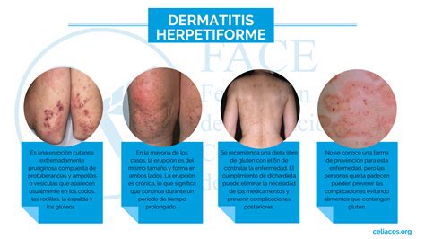 Zonas del cuerpo afectadas por la dermatitis herpetiforme