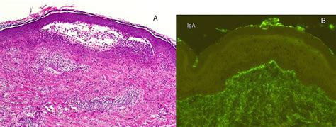 Microscopía de piel con dermatitis herpetiforme: depósitos de IgA