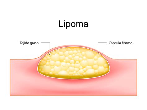 Comparación entre lipoma subcutáneo y lipoma intraóseo