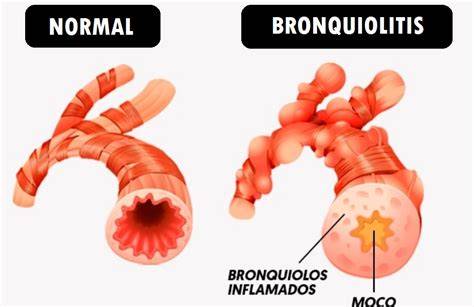 Esquema de los bronquiolos afectados por inflamación
