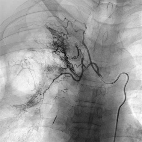 Arteriografía aortorrenal mostrando estenosis