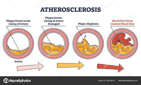 Diagrama de la formación de aterosclerosis