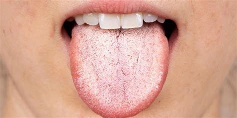 Ilustración de una lengua blanca con capa blanquecina