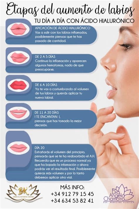 Infografía sobre cuidados post-tratamiento de relleno labial