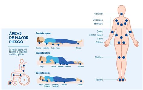 Anatomía humana mostrando las zonas de riesgo de úlceras por presión