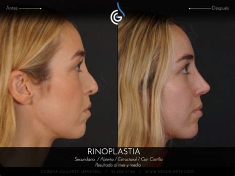Comparación pre y postoperatoria de rinoplastia con injerto de costilla