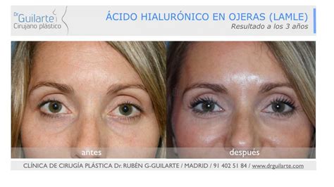 Técnica de inyección de ácido hialurónico en ojeras