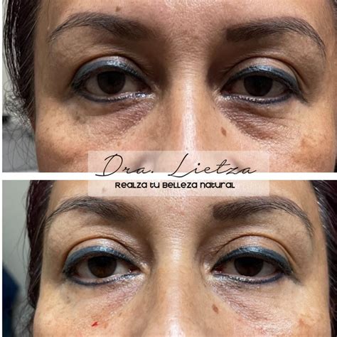 Antes y después de relleno de ojeras con ácido hialurónico