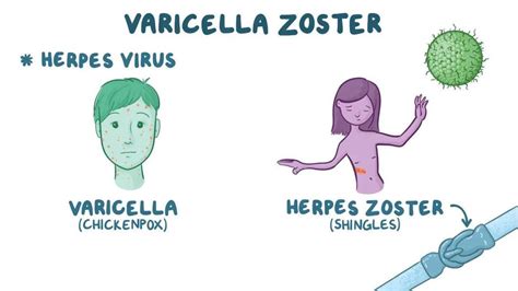 Ilustración del virus de la varicela-zóster