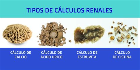 Cálculos renales ilustración