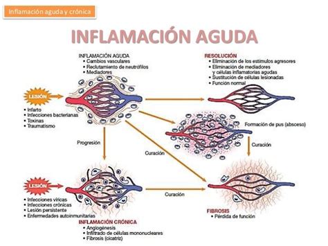 Esquema de la inflamación aguda versus inflamación crónica