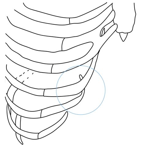 diagrama del síndrome de la costilla deslizante