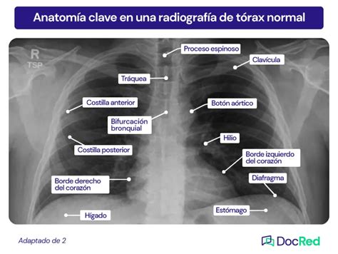 Radiografía de tórax mostrando posibles lesiones en las costillas