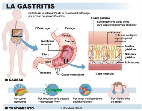 Esquema de las causas de la gastritis
