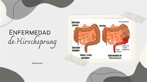 Esquema del intestino grueso mostrando la enfermedad de Hirschsprung