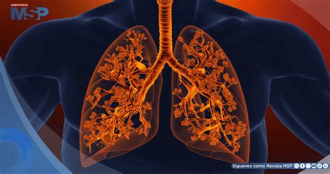 Pulmones afectados por la bronquiolitis obliterante