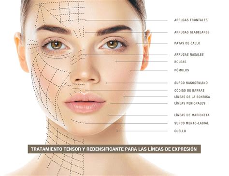 Esquema de aplicación de relleno facial en distintas zonas del rostro