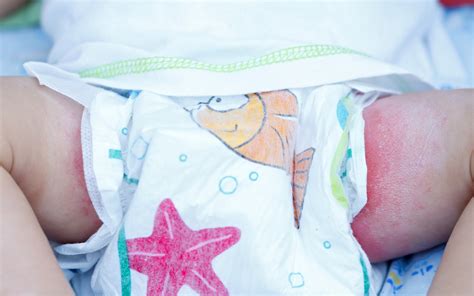 Representación de un bebé con dermatitis del pañal