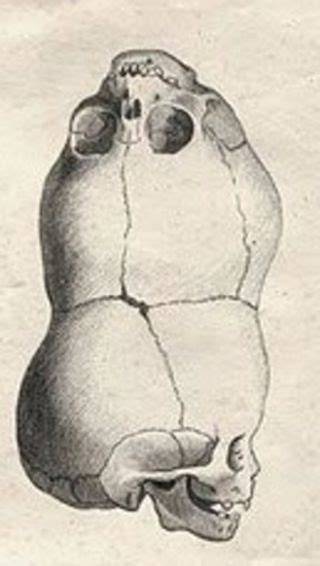 Representación de craniopagus parasiticus